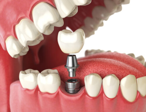 Dental Implants: Debunking Myths, Restoring Smiles