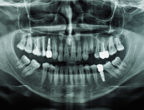 The Truth About Root Canals: What to Expect and Why They’re Safe