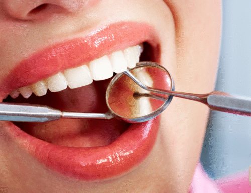 The Importance of Onlays for Restoring Teeth